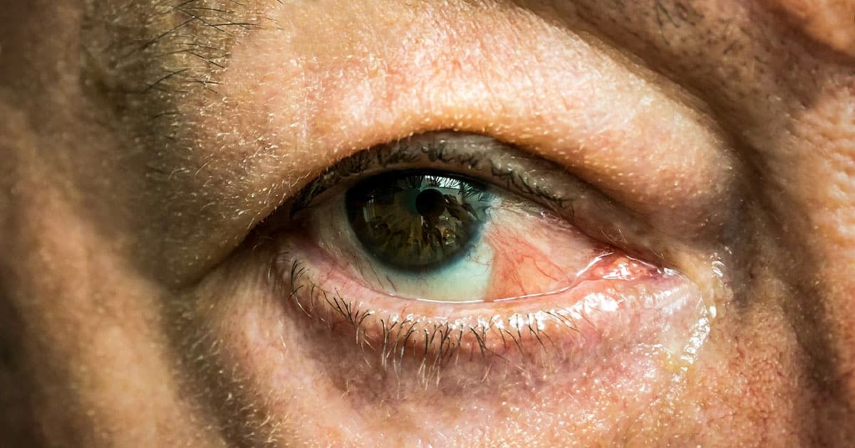 Eye With Pseudopterygium