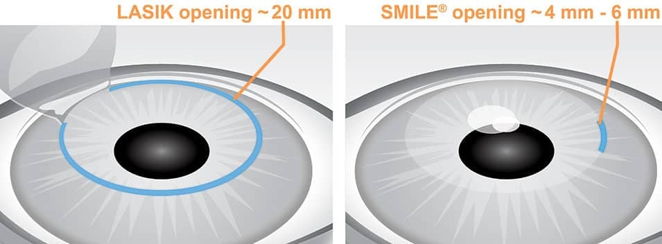 Lasik vs. SMILE Incision