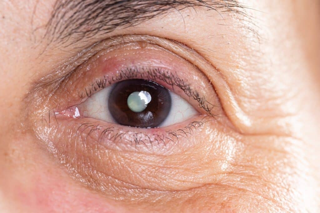 Cataract Surgery