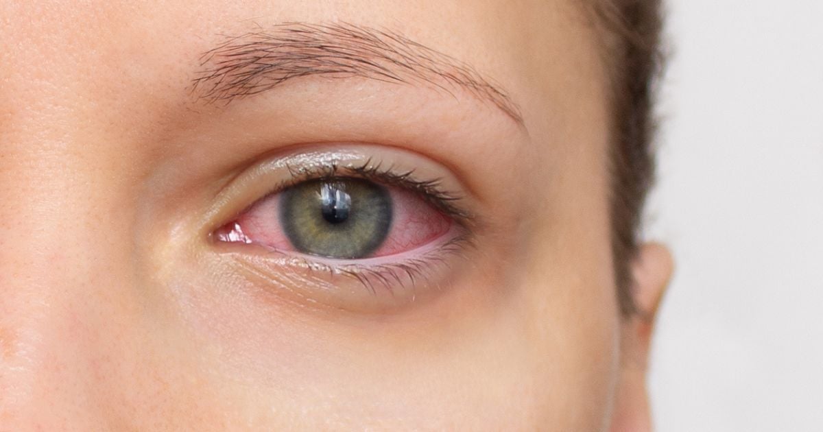 A close up of a woman's red, iritated eye caused by MGD and dry eye.