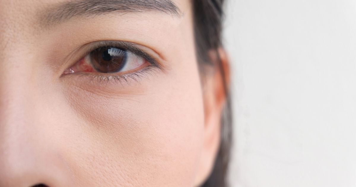 A close up of a woman's eye red from dry eye issues.