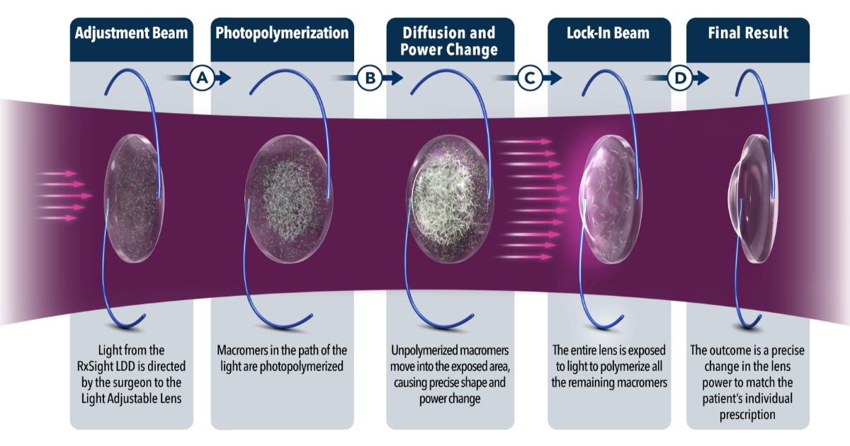 A graphic showing the different steps of light adjustable lens procedure.