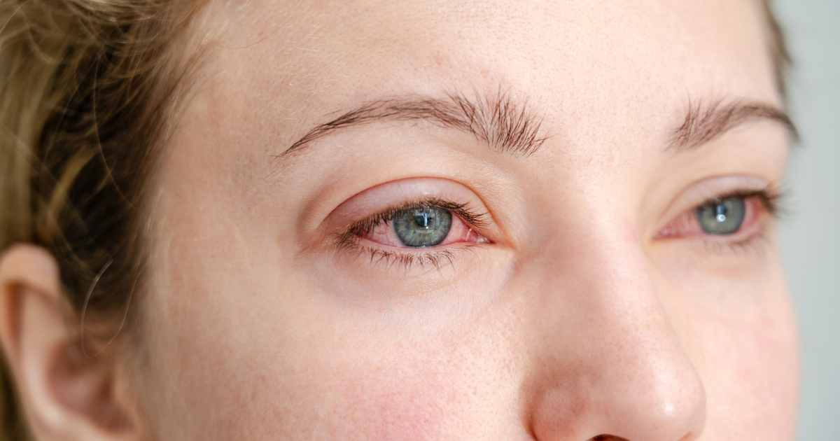 A close up of a woman's face with red eyes from allergies.
