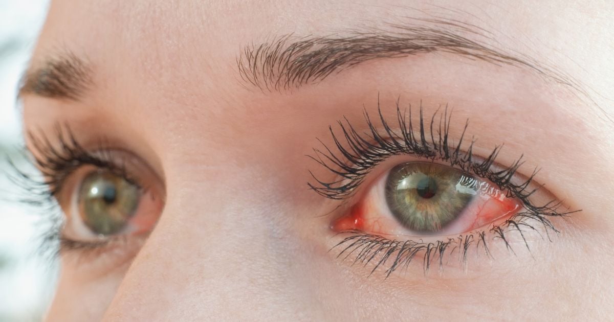 A woman with red eyes caused by evaporative dry eye.