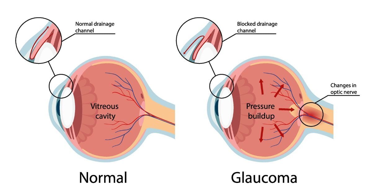A graphic showing the different between a normal eye and an eye with glaucoma.