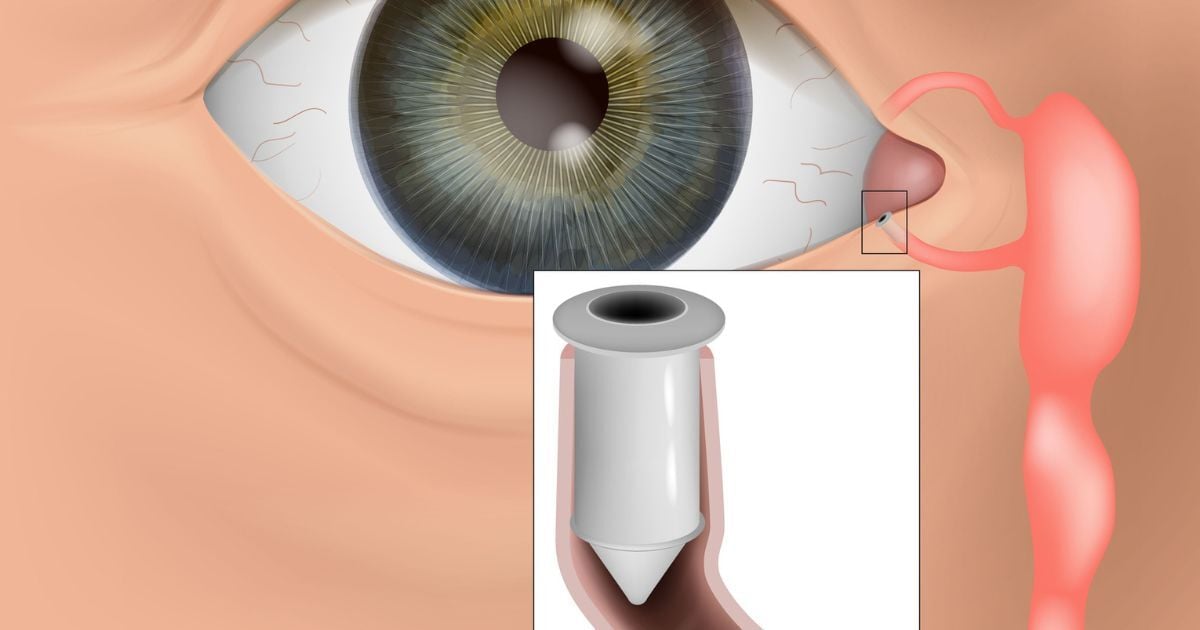 An illustration of an eye and inner eye corner with a punctal plug placed.