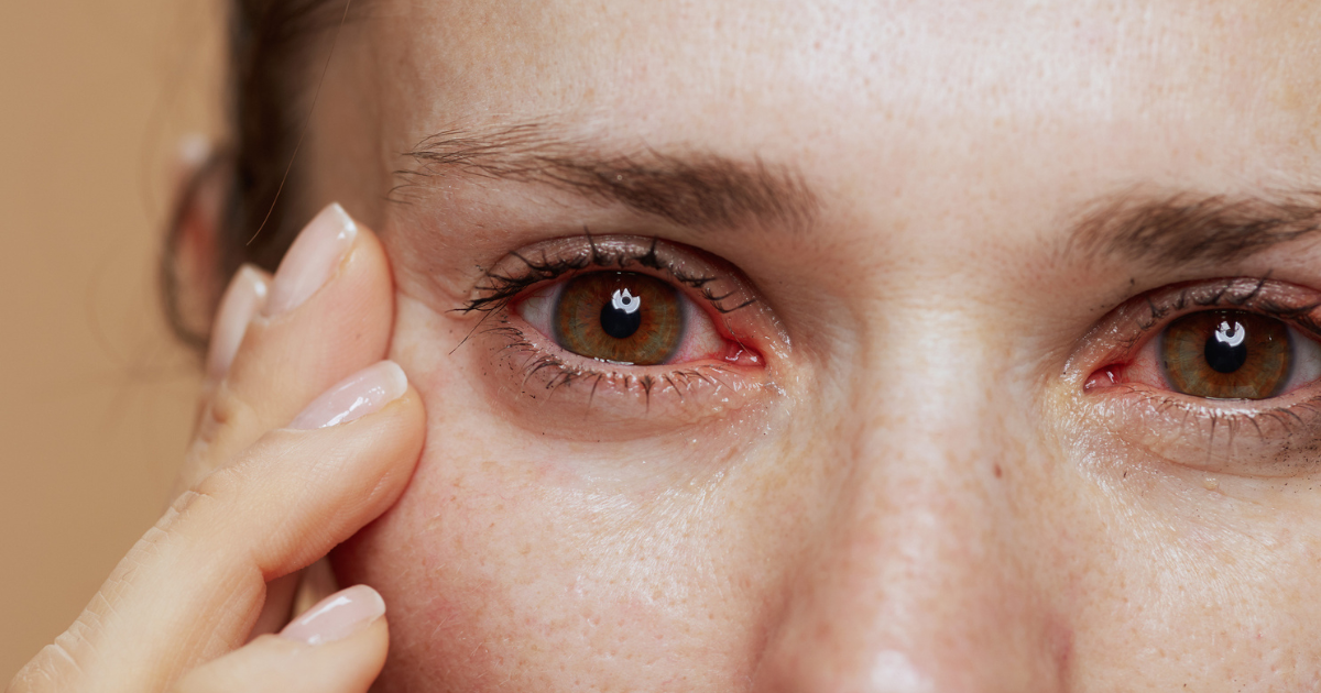 Eye Allergies Bothering You? Try These Daily Allergy-Proofing Tips