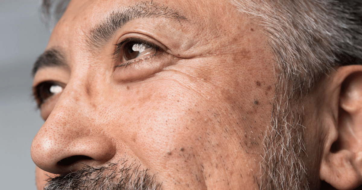 Diabetic Retinopathy Explained: Stages, Symptoms, and Treatments