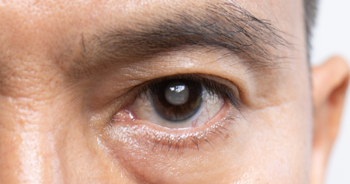 What Causes Cataracts and How Can They Be Treated?